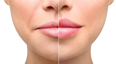 Dermal Filler Aftercare Dos and Donts : Tips for a Smooth Recovery